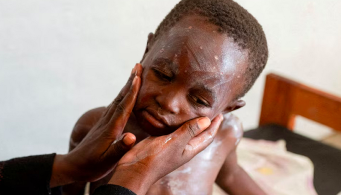 Wabah Penyakit Flu Mewabah di Kongo